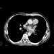 Lung carcinoma, pulmomediastinal form: CT - Computed tomography